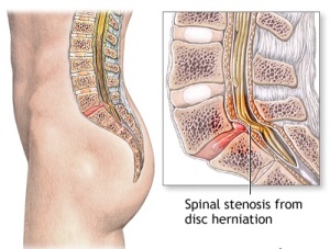 Spinal Stenosis 1