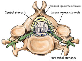 Foraminal stenosis