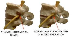 Foraminal Stenosis Treatment