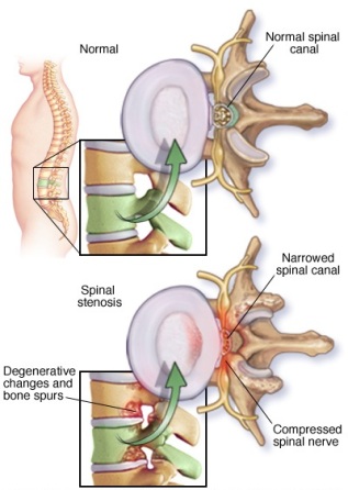 mcdc7_spinal_stenosis