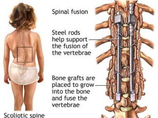 spinal_fusion_surgery